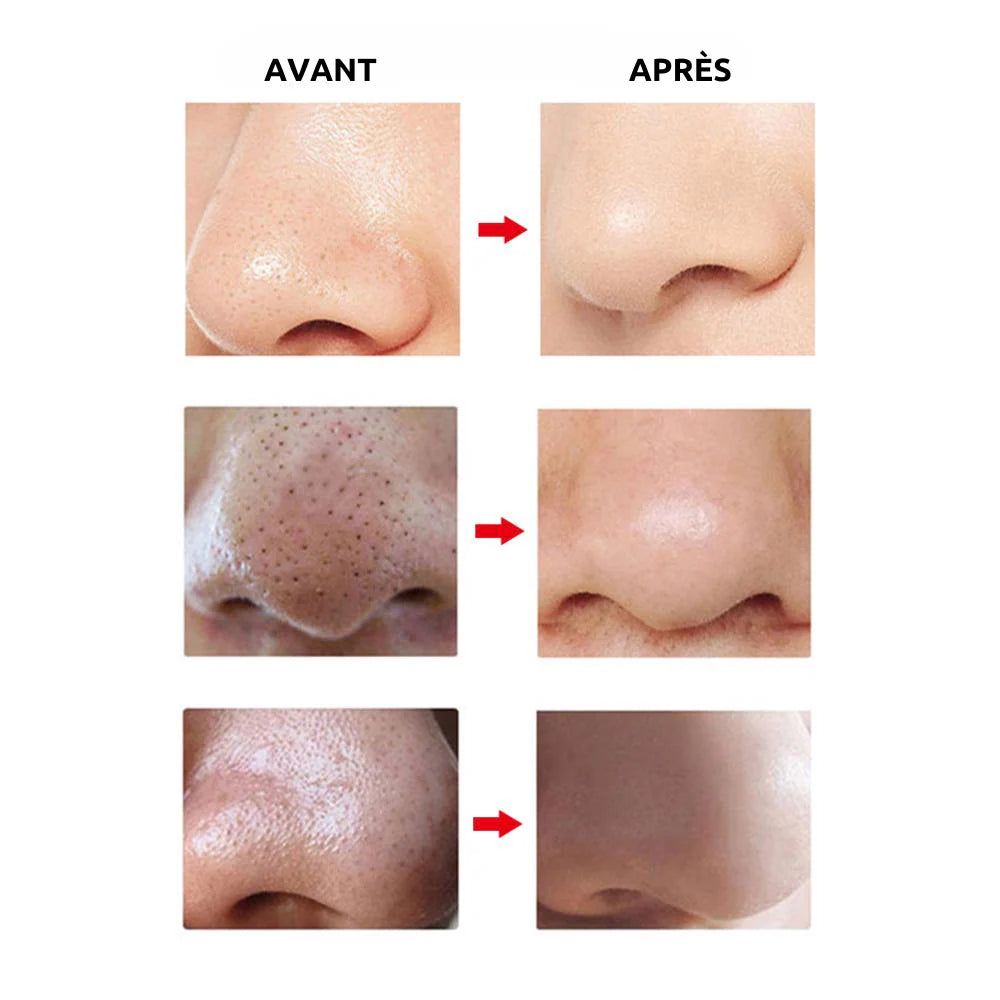 Résultats avant et après utilisation de l'aspirateur à points noirs AcneAway