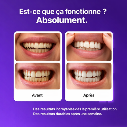 Résultat éclatant avec le kit de blanchiment des dents sans peroxyde pour dents sensibles