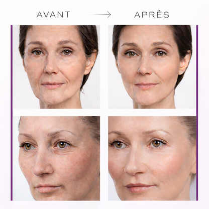 Comparaison avant-après : peau lissée et rides réduites avec le baume au calcium.