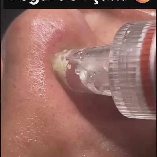 Démonstration utilisation aspirateur à points noirs AcneAway sur le visage