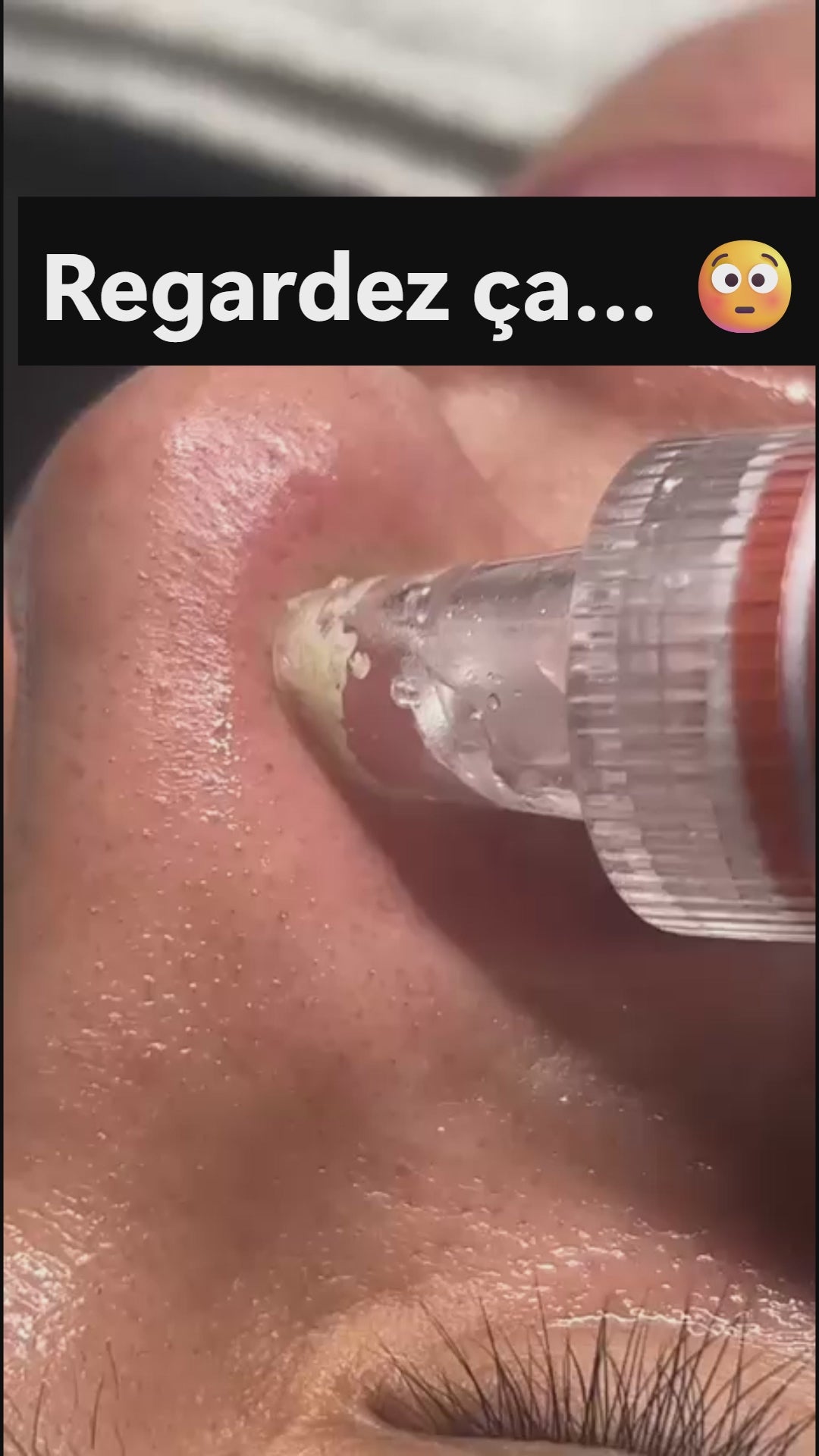 Démonstration utilisation aspirateur à points noirs AcneAway sur le visage